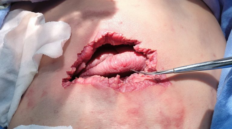 chirurgie majeure laissant des cicatrices